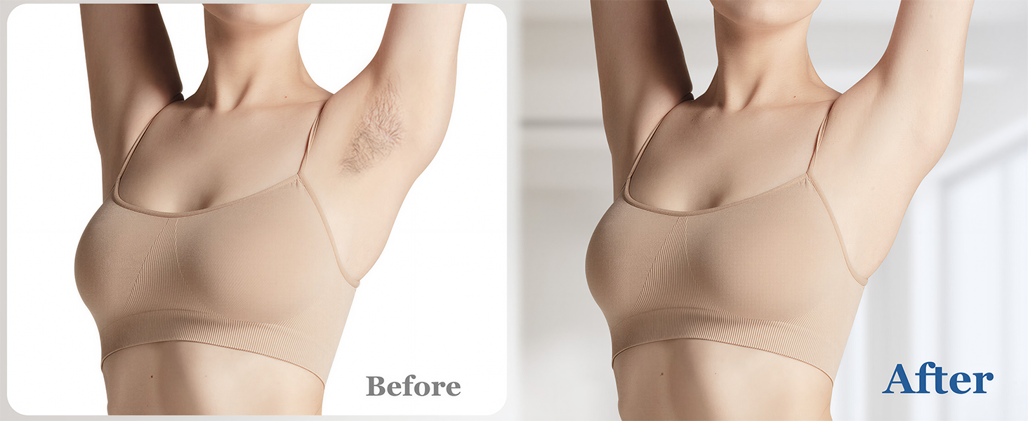 Xsoul IPL Rose Gold — before and after underarm hair removal comparison, permanent reduction results