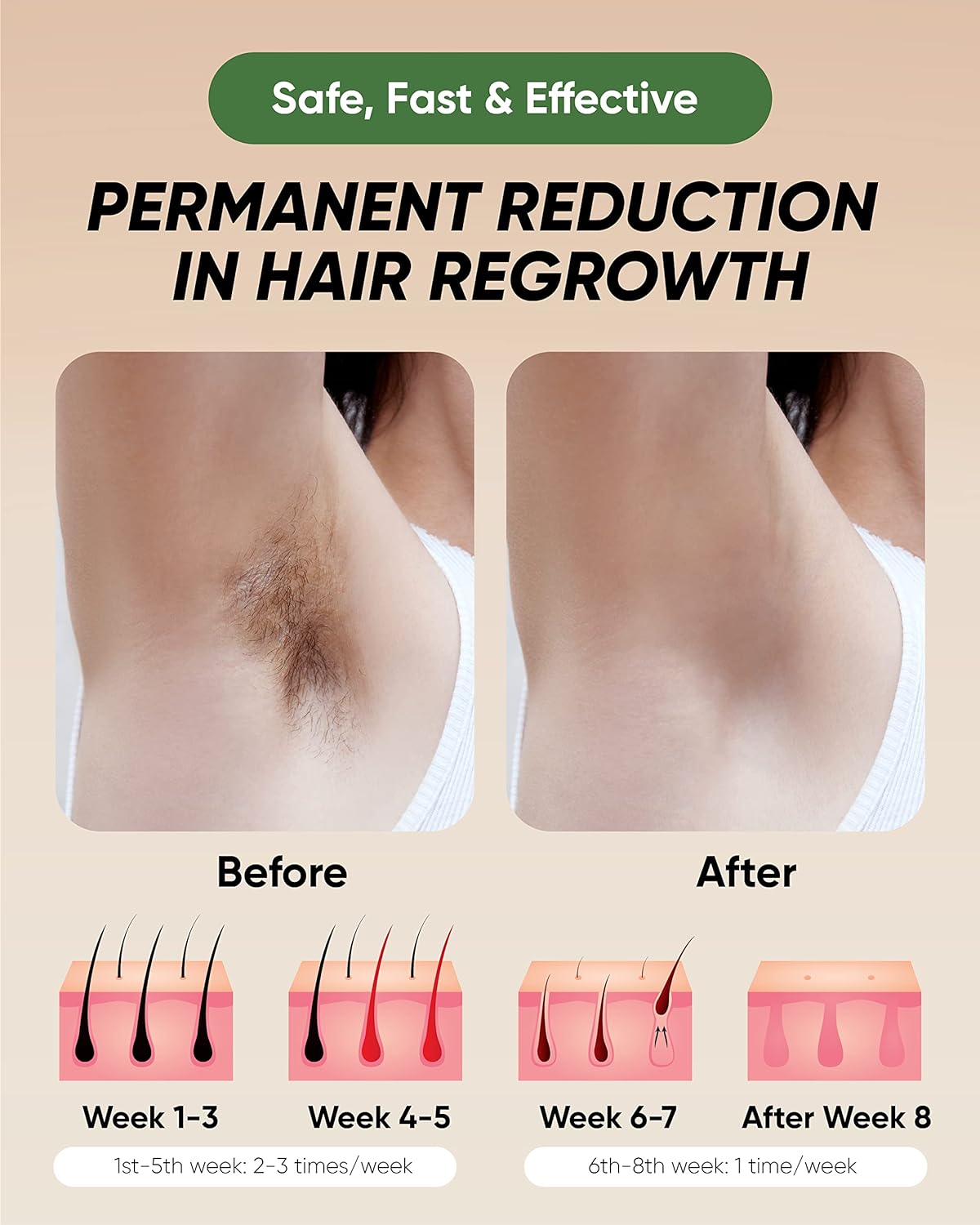 a poster of a person's armpit with text: 'Safe, Fast & Effective PERMANENT REDUCTION IN HAIR REGROWTH Before After Week 1-3 Week 4-5 Week 6-7 After Week 8 1st-5th week: 2-3 times/week 6th-8th week: 1 time/week'